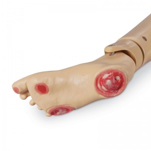 Optional Pressure Ulcer Foot