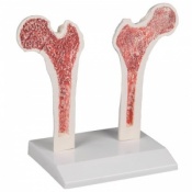 Erler-Zimmer Osteoporosis Femur Model