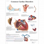 3B Scientific Common Cardiac Disorders Pathology Poster (Laminated)