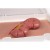 Erler-Zimmer Protrusion of Large Intestines Wound Moulage
