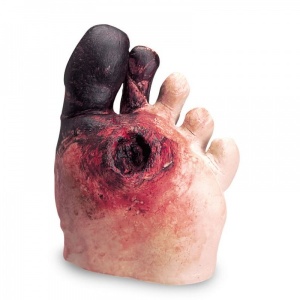 Erler-Zimmer Educational Diabetic Foot Model