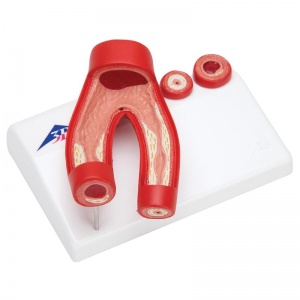 Arteriosclerosis Model with Cross-Section of Artery