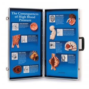 Consequences of High Blood Pressure 3D Display