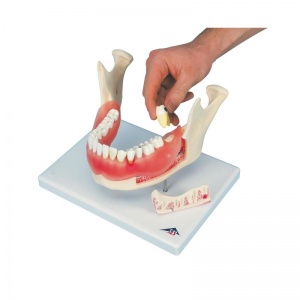 Dental Disease Model (21-Part)