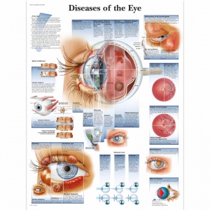 Diseases of the Eye Chart