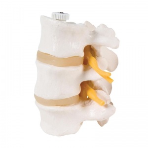 Two Lumbar Vertebrae with Prolapsed Disc