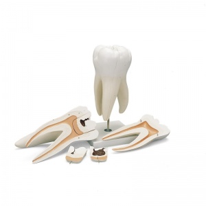 Giant Molar Model with Dental Cavities (5-Part)