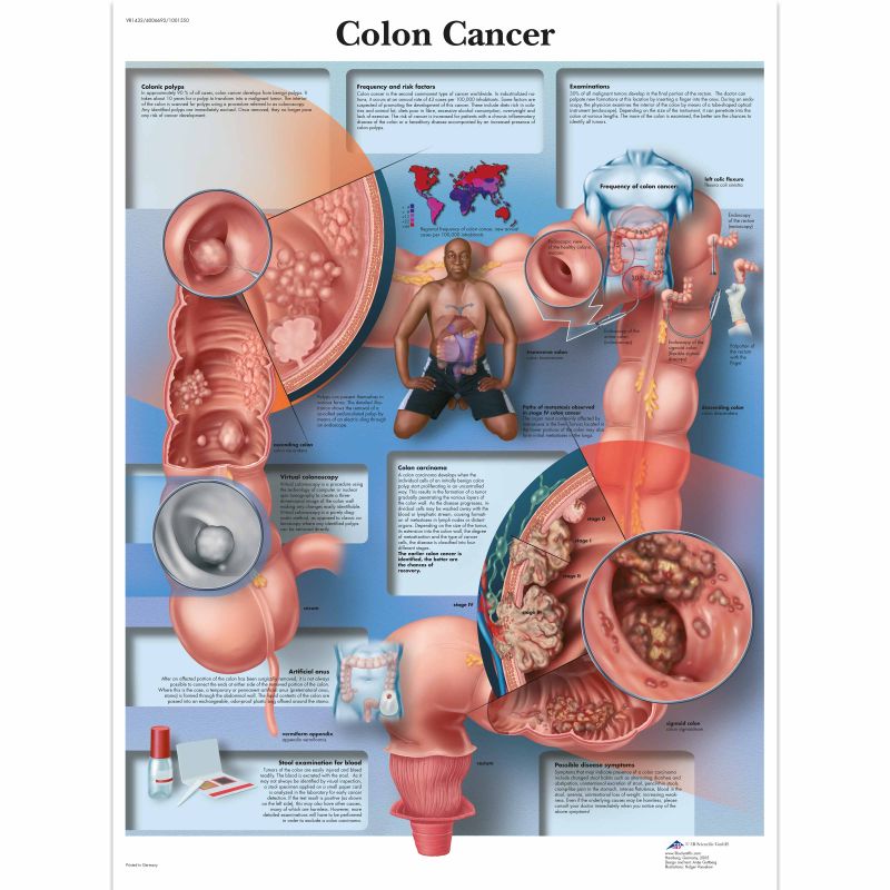 Colon Cancer Chart
