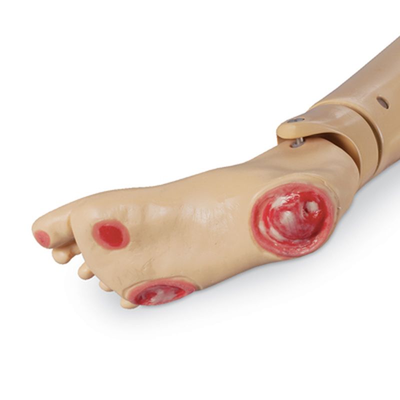 Optional Pressure Ulcer Foot
