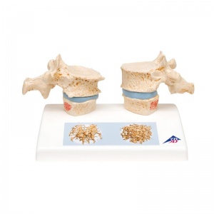 Osteoporosis Model