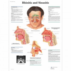 Rhinitis and Sinusitis Chart