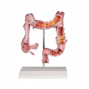 Erler-Zimmer Colon Model with Diseases